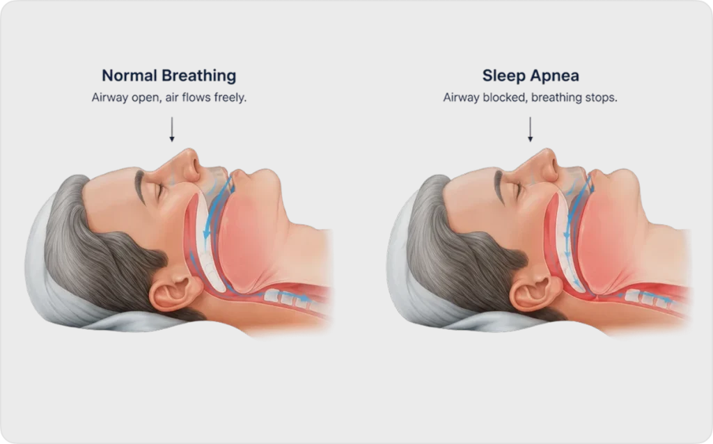 An graphic showing the difference between normal breathing and sleep apnea